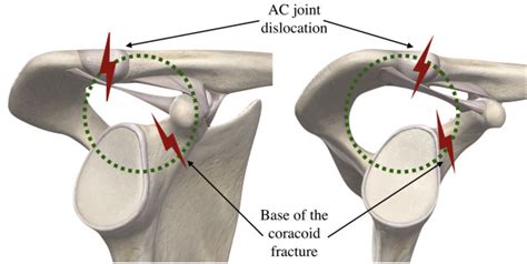 Acromioclavicular Joint Dislocation Associated With A Coracoid Process