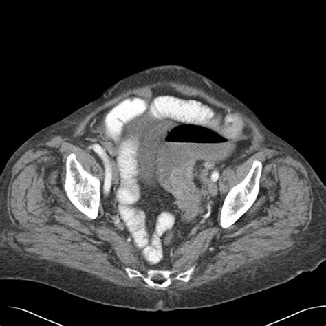 Axial Ct Image Of A Diverticular Stricture With Symmetrical Bowel Wall