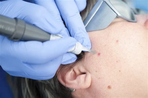 Recovery After V Beam Laser Acne Treatment