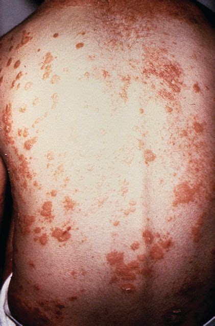 No Evidence Of Subclinical Axial Involvement Seen In Skin Psoriasis