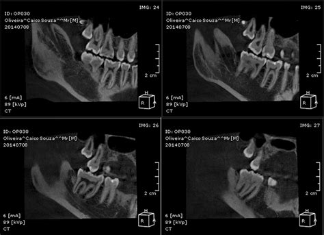 Ct Scan Performed On Cbct Op300instrumentarium Dental Sagittal