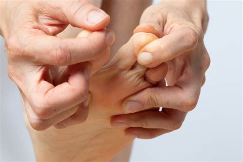 Learn About Athletes Foot Treatment Community Foot Clinic Of Mcpherson