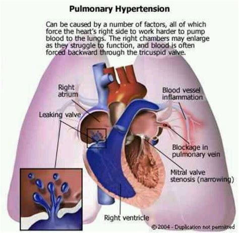 132 Best Pulmonary Hypertension Images On Pinterest Pulmonary