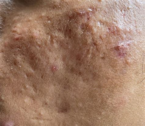 Bad Acne Scarring Need Help Pls Scar Treatments