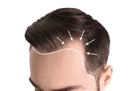 Receding Hairline Causes Stages Treatment And Hairstyles Traya