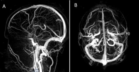 Cerebral Angiography Anatomy