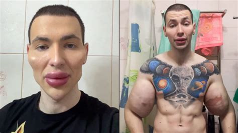 Video The Synthol Kid Gets Alien Injections In Face Refusing Doctor Recommendations