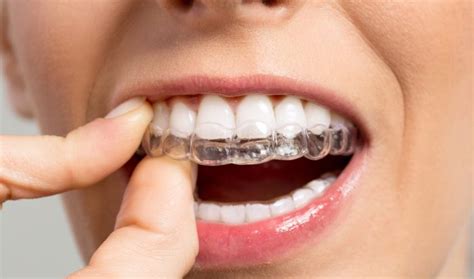 But the only downside to using this product is that it is not permanent. Can You Fix An Overbite With Invisalign? - Fine ...