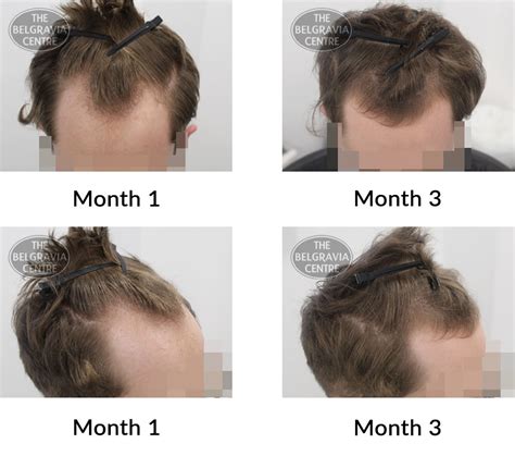 Hair Growth Success Story My Experience Has Been Excellent