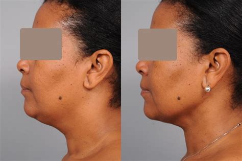 Smartlipo™ Neck Liposuction In New York Dr Sterry