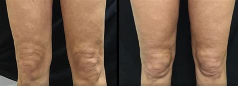 Thermage In Thigh And Knee Area 3 Months