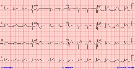 Cureus Acute ST Elevation Myocardial Infarction Caused By