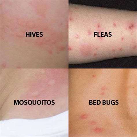 Do You Think You Have Bed Bugs Read About The Symptoms And Signs Look At The Photos And Find