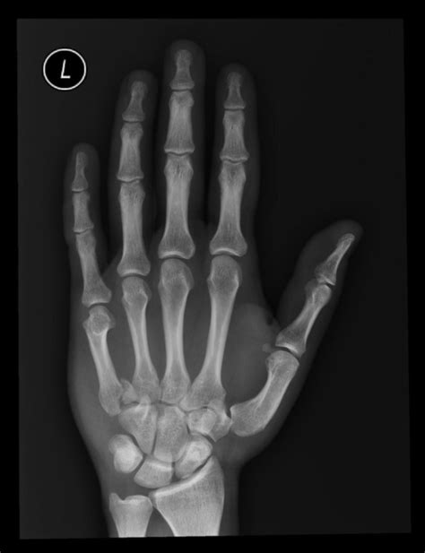 Finger Injuries Basics And Bones Dont Forget The Bubbles