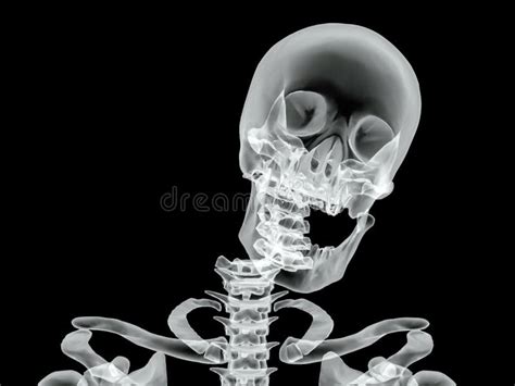 Vector Broken Bone X Ray Image Stock Vector Illustration Of Anatomy