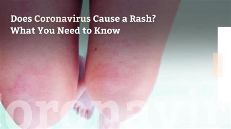 Does Coronavirus Cause A Rash What You Need To Know
