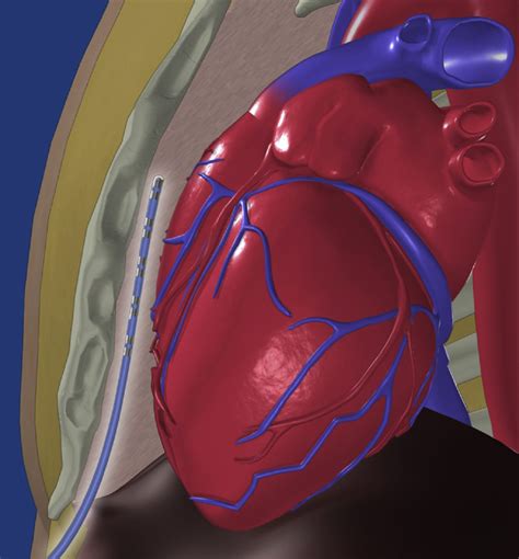 Feasibility Of Extravascular Pacing With A Novel Substernal Electrode