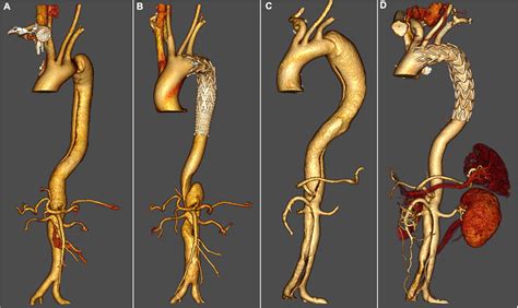 Outcomes Of Thoracic Endovascular Aortic Repair With Fenestrated