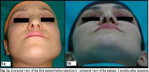 Figure 1 From Treatment Of Masseteric Hypertrophy With Botulinum Toxin