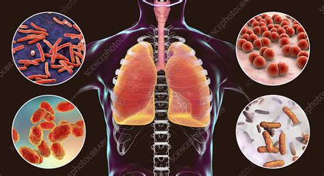 Bacteria That Cause Lung Infections Illustration Stock Image F023