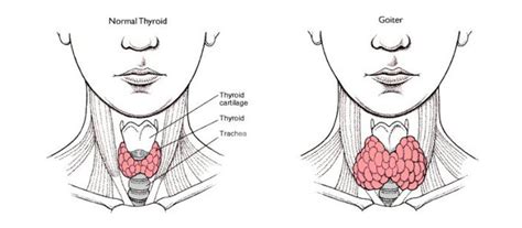 Multinodular Goitre Thyroid Sydney