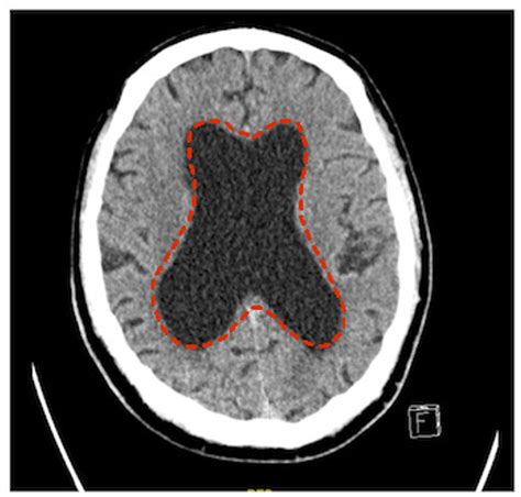 Cureus The Typical Triad Of Idiopathic Normal Pressure Hydrocephalus In A 62 Year Old Male