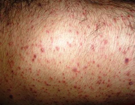 Skin Rash And Pneumonia In A Young Male Bmj Case Reports