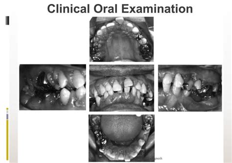 Case Report Chronic Generalized Periodontitis With Type 2 Dm