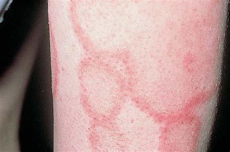 What Is Discoid Lupus Pictures Photos