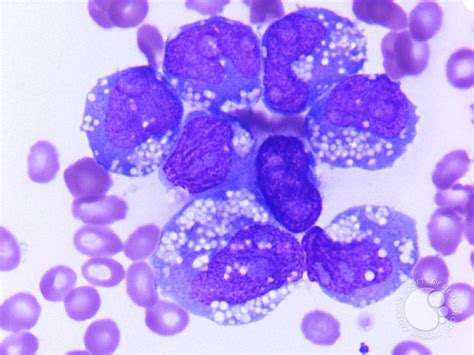 Acute Myeloid Leukemia With Histiocytic Differentiation 1