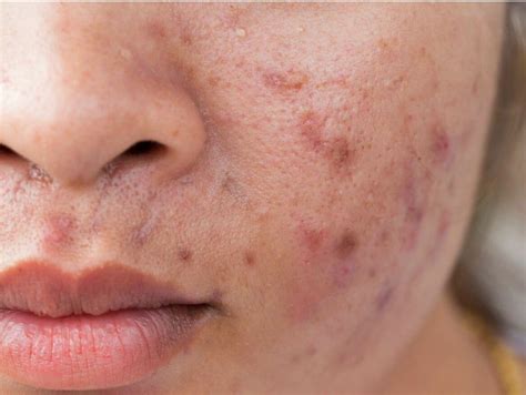 The Maskne Epidemic Whats Really Causing The Acne Around Your Mouth