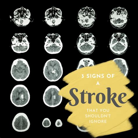 3 Signs Of A Stroke That You Shouldnt Ignore Premier Neurology