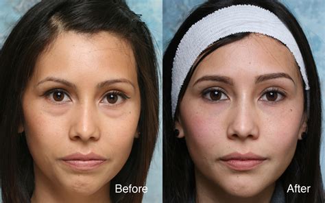Dark Circles Surgery Beverly Hills How To Get Rid Of Eye Bags