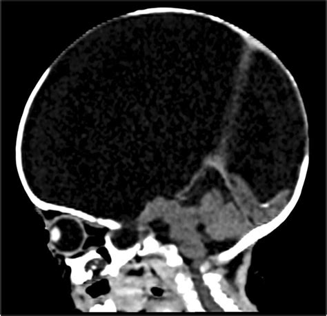 Mid Sagittal Cut Of The Plain Cranial Ct Scan Shows Absence Of The