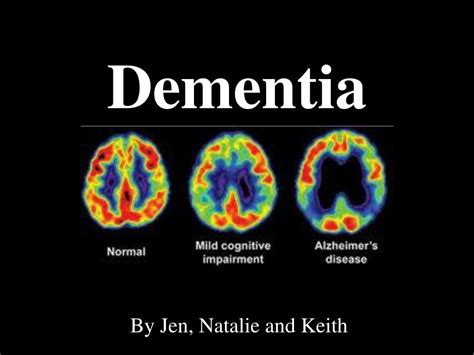 Ppt Dementia Powerpoint Presentation Free Download Id3059274