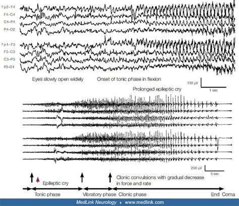 Epilepsy With Generalized Tonic Clonic Seizures Alone Medlink Neurology