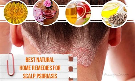 Home Remedies For Psoriasis Home Remedies For Scalp Psoriasis Dry