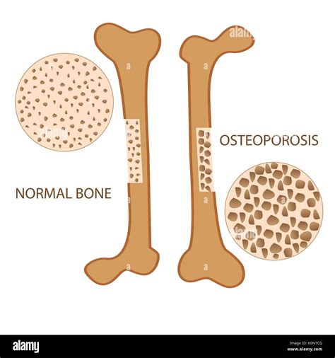 Osteoporosis Bone Anatomy Versus Normal Health Bone Vector Format