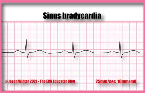 Ecg Educator Blog Sinus Bradycardia