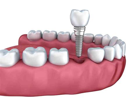 What Is A Mini Dental Implant Dental News Network