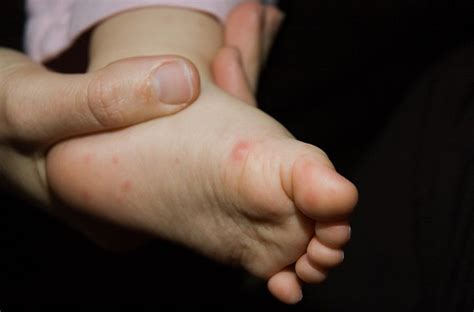 Explainer Why Children Are At Risk Of Hand Foot And
