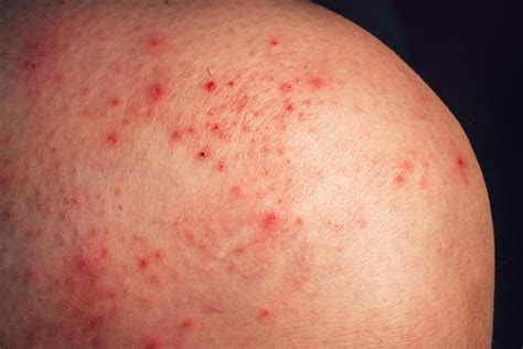Does Stress Cause Petechiae Lovetoknow Health And Wellness