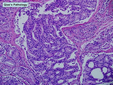 Qiaos Pathology Adenocarcinoma Of The Prostate Gleason Pattern 4 A