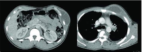 A B Two Chest Wall Masses With Enlarged Left Hilar Node Showing