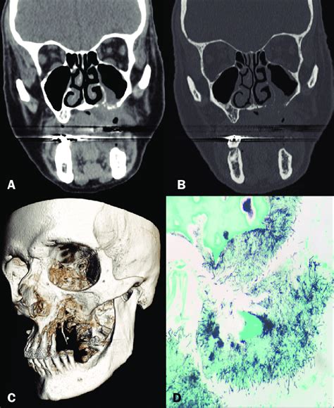 Tomografia Computadorizada Dos Seios Da Face Com Janela De Parte Moles Download Scientific