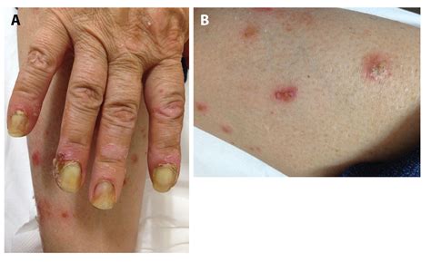 An Atypical Case Of Pustular Psoriasis Presenting With Severe Subungual