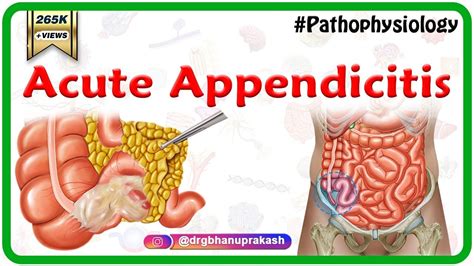 Acute Appendicitis USMLE Step 1 Etiology Pathophysiology Clinical