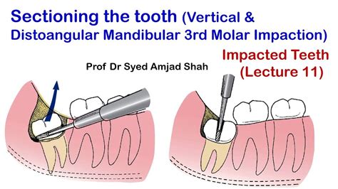 Sectioningcutting Tooth Vertical And Distoangular Impacted Mandibular