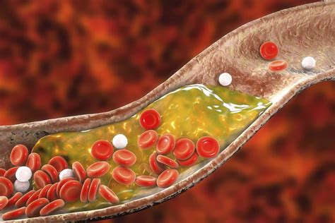 Lowering Blood Cholesterol Your Health