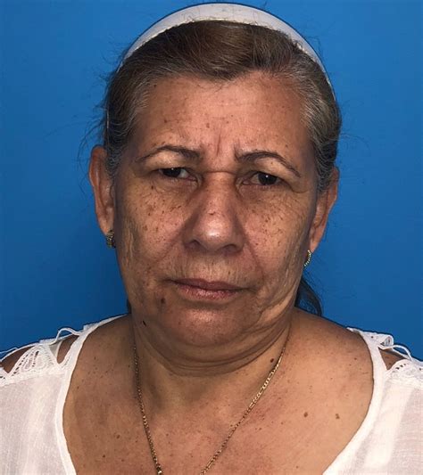 When a labiaplasty is considered medically necessary, this can be billed through if you need more help answering the question, is labiaplasty covered by insurance? or for actual labiaplasty cost, please contact us. Silhouette Instalift Case 2481 - Florence Mussat M.D, S.C.